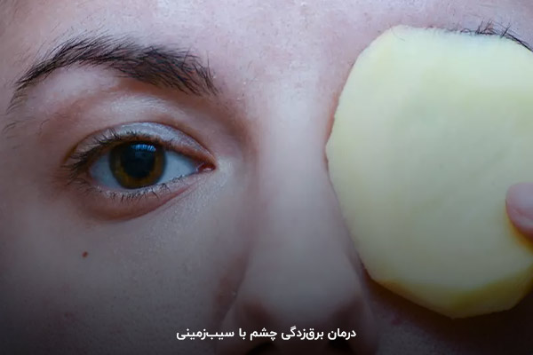 استفاده از خواص سیب‌زمینی برای درمان برق‌زدگی چشم